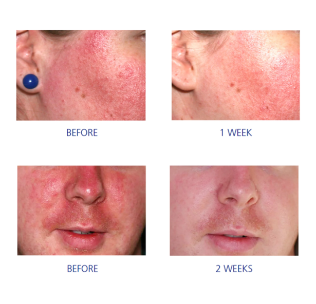 NOWOŚĆ Pro-Heal Serum iS Clinical – Twoje rozwiązanie na podrażnienia, zaczerwienienia i trądzik